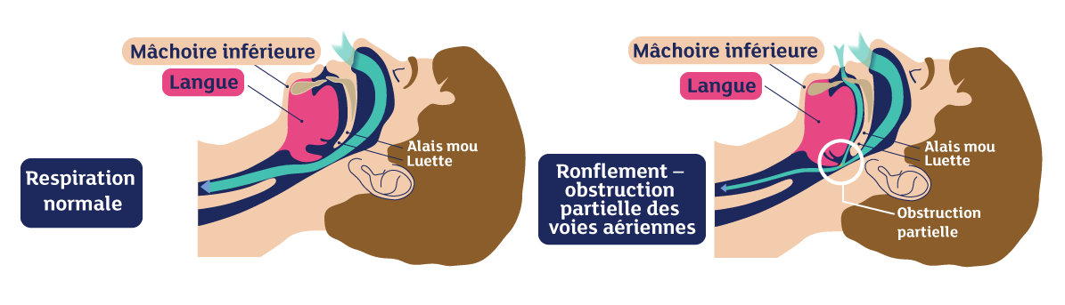 Pourquoi je ronfle?